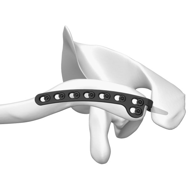 Clavicular Hook Locking Plate 15mm - Image 4