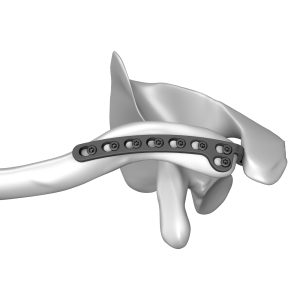 Clavicular Hook Locking Plate