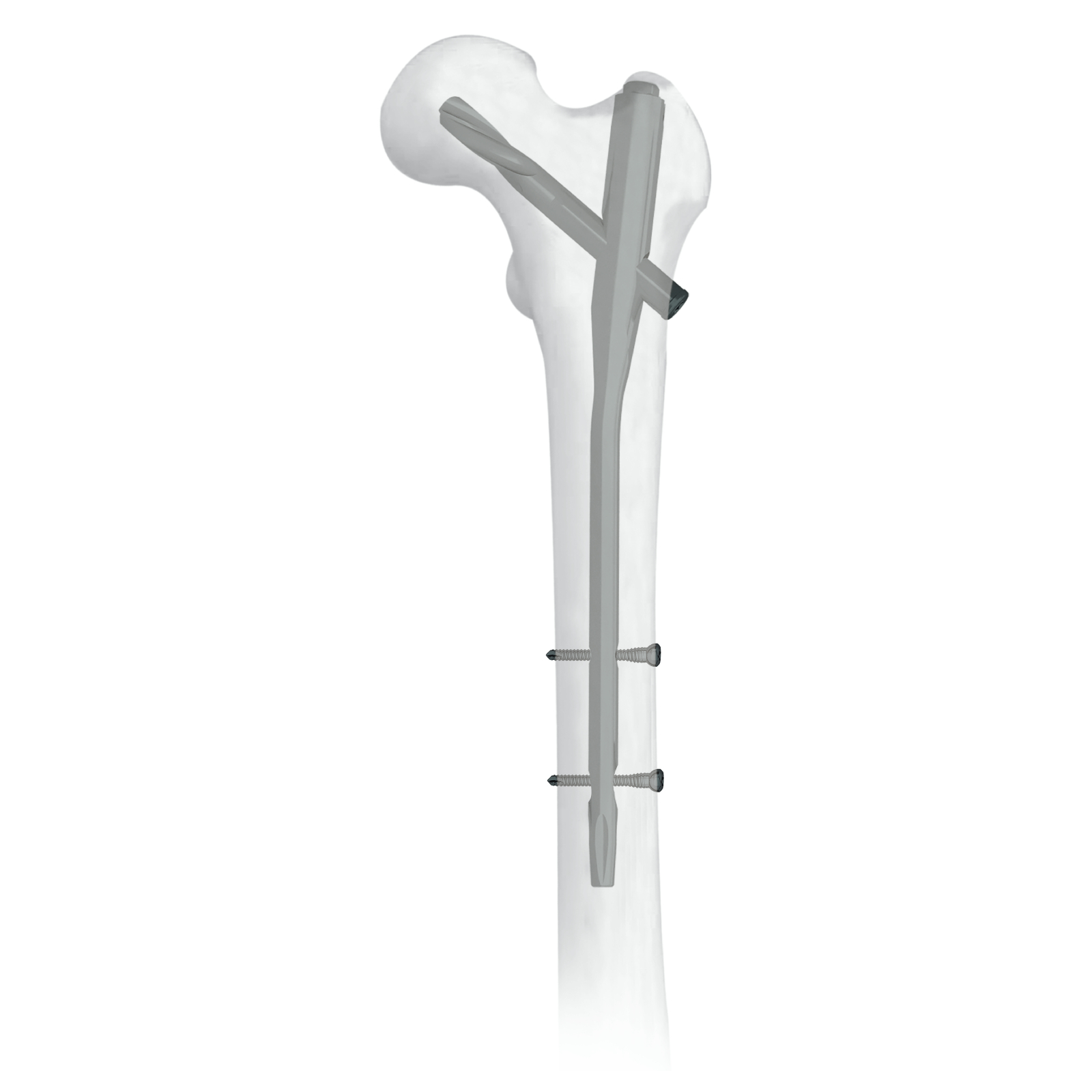 Proximal Femoral Nail 9mm 130° (long) (right & Left) - Otpeople