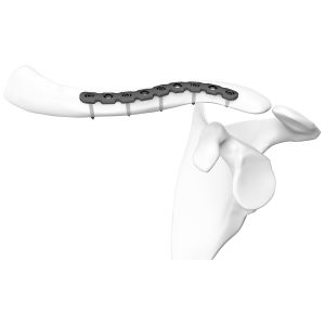 Clavicular Locking Plate
