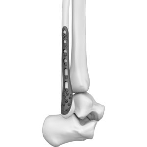 Distal Lateral Fibular Locking Plate