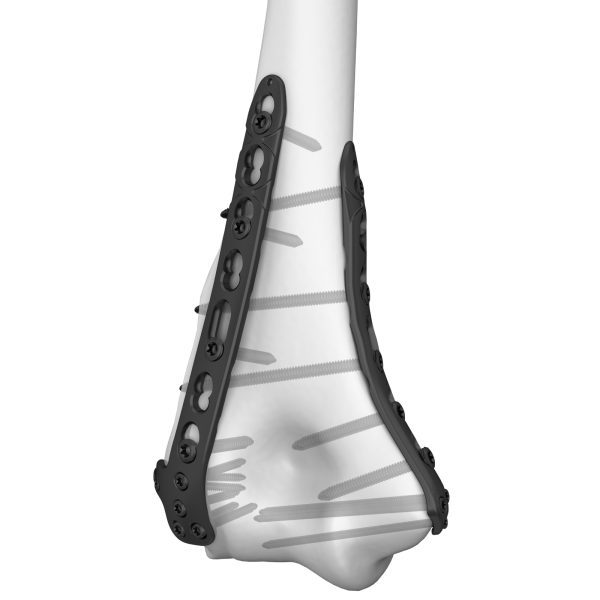 Distal Medial Humeral Locking Plate - Image 3