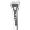 Distal Radius Locking Plate Variable Angle Small