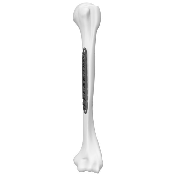 Humeral Shaft Straight Locking Plate - Image 3