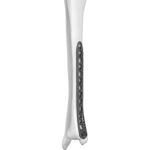 Low Profile Distal Medial Tibial Locking Plate