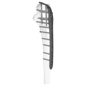 Olecranon Locking Plate