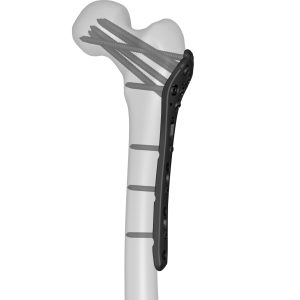 Proximal Femoral Locking Plate