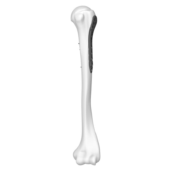 Proximal Humeral Locking Plate Ⅱ - Image 3