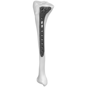 Proximal Lateral Tibial DR Locking Plate
