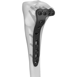 Proximal Lateral Tibial SR Locking Plate