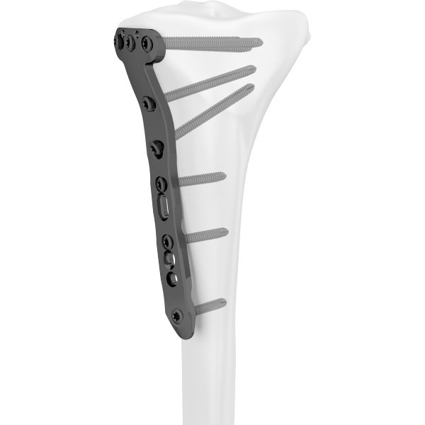 Proximal Medial Tibial T-Locking Plate - Image 2