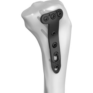 Proximal Medial Tibial T-Locking Plate