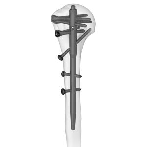 Advanced Humeral Nail Short