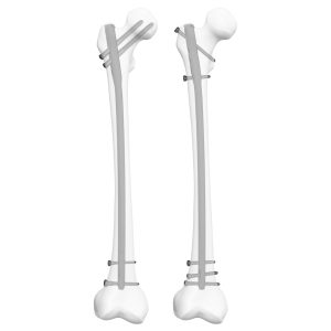 Femoral Nail