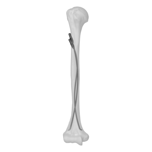 Titanium Elastic Nail