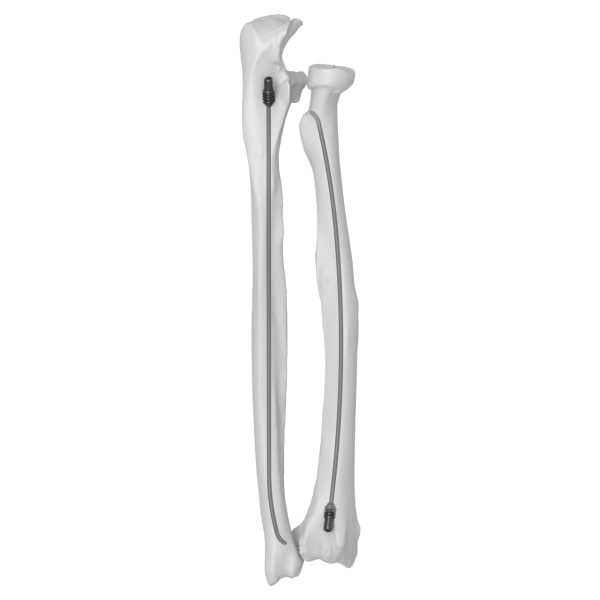 Titanium Elastic Nail - Image 3